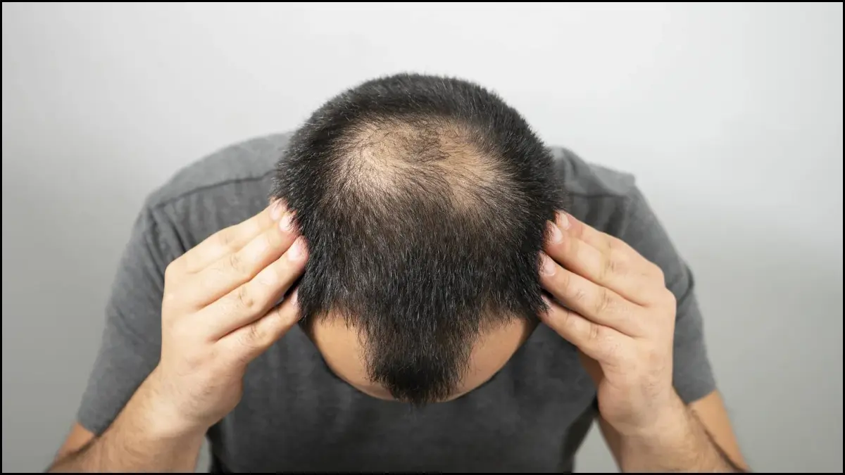 أسباب تساقط الشعر عند النساء والرجال وطرق العلاج الحديثة